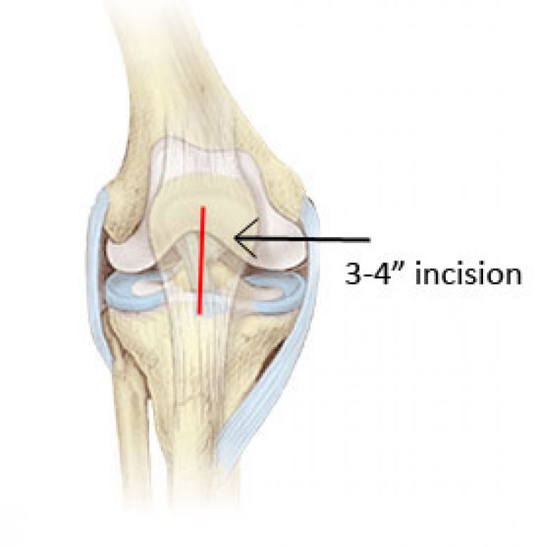 Minimally Invasive Partial Knee Replacement - HKS Clinic