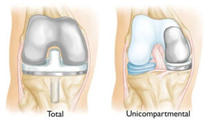 difference between a partial and a total knee replacement
